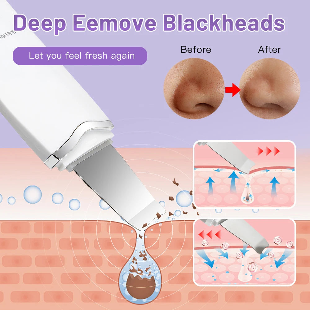 Luxury Ultrasonic Facial Cleansing Spatula – Peeling, Lifting and Blackhead Removal for Radiant Skin