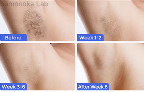 Luxury IPL Laser Hair Removal for Women – Permanent Hair Removal for Face and Body with Advanced Technology