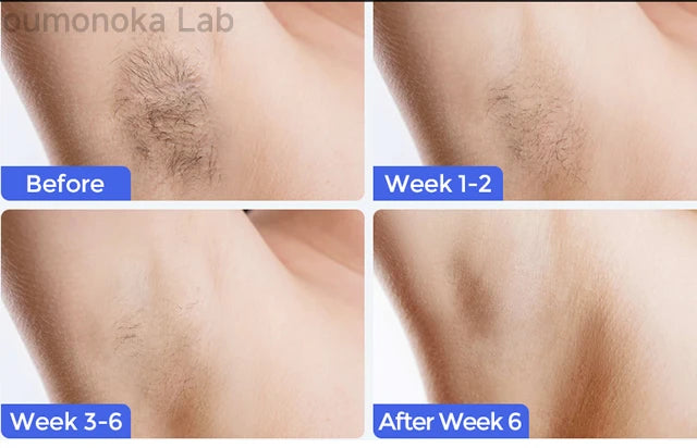 Luxury IPL Laser Hair Removal for Women – Permanent Hair Removal for Face and Body with Advanced Technology