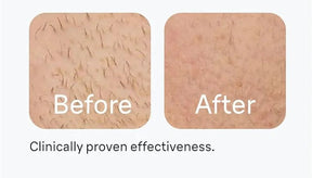 Luxury IPL Laser Hair Removal for Women – Permanent Hair Removal for Face and Body with Advanced Technology