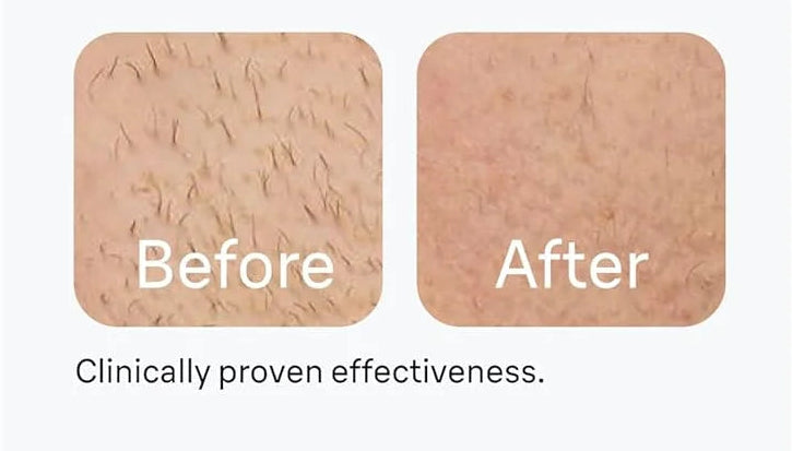 Luxury IPL Laser Hair Removal for Women – Permanent Hair Removal for Face and Body with Advanced Technology