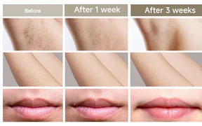 Luxury IPL Laser Hair Removal for Women – Permanent Hair Removal for Face and Body with Advanced Technology