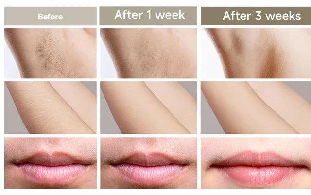 Luxury IPL Laser Hair Removal for Women – Permanent Hair Removal for Face and Body with Advanced Technology